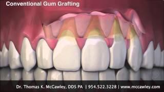 Fort Lauderdale, FL Periodontist Dr. McCawley Shows PST Procedure