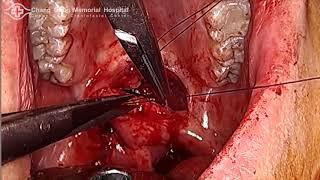 Double Opposing Z Plasty for Velopharyngeal Insufficiency