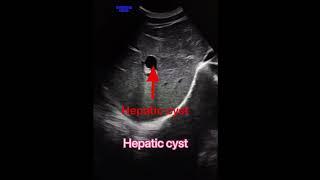 Hepatic cyst usg#radiology #usg4d #ultrasound #ultrasoundscans #sonography #medicalstudent #medical