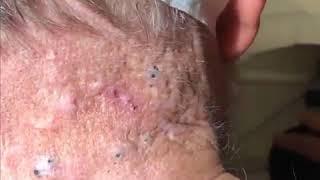 Blackhead on body.. Satisfying gross...