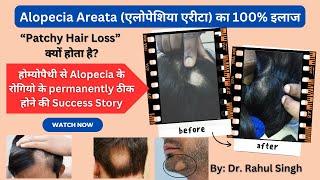 Alopecia Areata के बारे में पूरी जानकारी, Success Story Alopecia Areata | Best Homeopathic Treatment