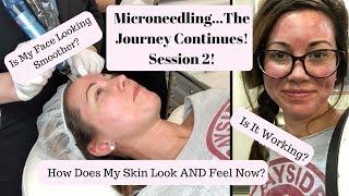 Microneedling Procedure for Acne Scars & Textured Skin: Part Two