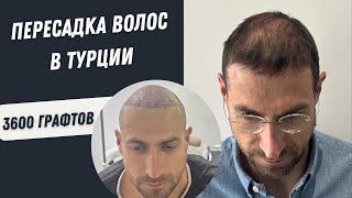 Пересадка волос в Турции | Пересадка Волос процесс 3600 графтов #пересадкаволос