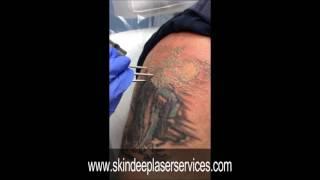 Shoulder Laser Tattoo Removal, Skin Deep Laser Services, Alexandria VA, ArlingtonVA, Fairfax VA