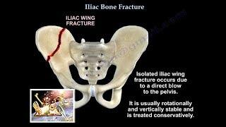 Iliac Bone Fracture - Everything You Need To Know - Dr. Nabil Ebraheim