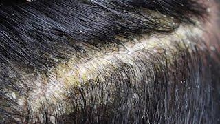 Dandruff scratching removal on head using black combing#54