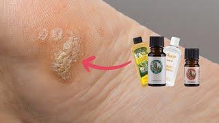 Combatting Warts with Melaleuca Products