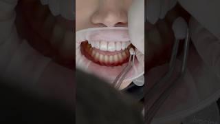 Incredible transformation with Porcelain Veneers!! #Dentalveneers #asmr #cosmeticdentistry