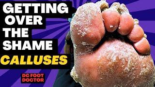 Getting Over The Shame, Part 2: Removing the Calluses