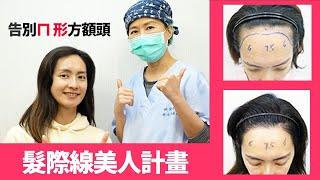 『植髮見證分享』 拯救女性寬大高額頭! 女性髮際線植髮 美人計畫一年成果『植髮推薦』台灣林宜蓉醫師 Dr. Yi Jung Lin 高地植髮家知識講堂