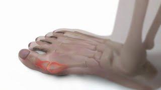 Battling bunions: What causes them, how they can be managed