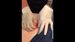 Dr Logan sebaceous cyst