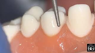 Step-by-step crown preparation for upper premolar. Препарирование под коронку верхнего премоляра.