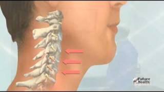 Treatment of Neck Pain by Future Health Software