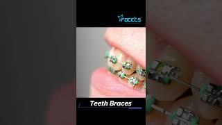 Affordable | Metal braces | Ceramic Teeth Braces | Clear Teeth Aligners Cost in Kochi, Kerala, India