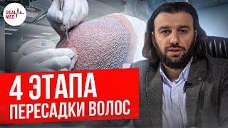 Как проводится операция: 4 важных этапа пересадки волос // Медицинский туризм