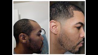 First Haircut After Hair Transplant- 6 Month Update