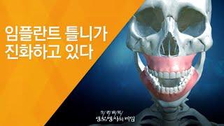 임플란트 틀니가 진화하고 있다 - (2014.6.18_506회 방송)_건강장수의 조건, 틀니