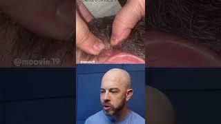 Shooting pimple gets stuck in hair! #dermreacts #doctorreacts #pimplepopper