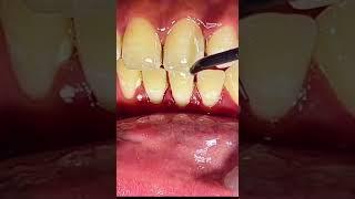 TEETH CLEANING (Oral Prophylaxis)