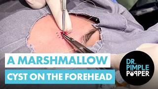 A Marshmallow Cyst on the Forehead