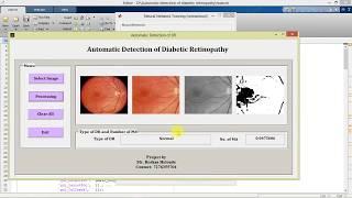 Diabetic Retinopathy Detection in Fundus Images Using Matlab Code