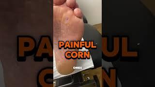 Painful corn callus ulceration removal on a patient with rheumatoid arthritis and diabetes