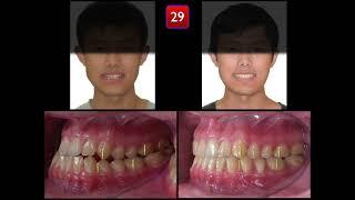 Skeletal Class III with functional shift | 【Chris Chang Ortho】CC822