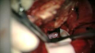 Clip reconstruction of giant vertebral artery aneurysm after failed flow reduction therapy