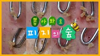 뽑아봐요 피지의숲 얼굴전체 여드름 제거하는 풀 영상! 좁쌀여드름, 화농성여드름 깔끔하게 피지 제거하는 속시원함! 여드름 제일 빨리 없애는 곳 - 스파비알