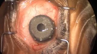 Iris Implant Removal | Brooks Eye Associates