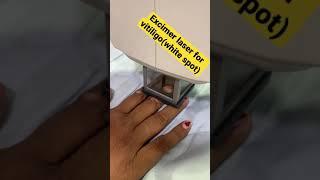 Excimer laser for vitiligo (white spot)