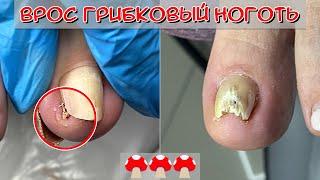 Ingrown Toenail / Toenail Fungus