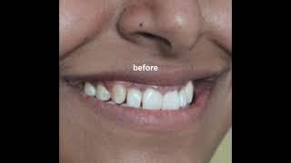 Overlapping teeth ?  Smile Makeover  Watch now !