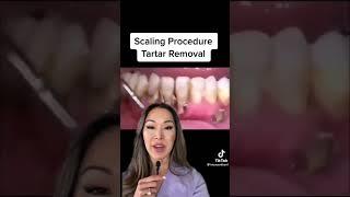 Scaling Procedure Tartar Removal #shorts