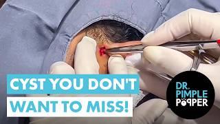 A Cyst You DON'T WANT to Miss!