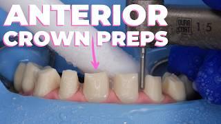 How To: Anterior Crown Preps with Dr. Lincoln Harris