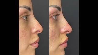 Non-Surgical Nose Job by dermal filler - Ageless MD of Dr. Tsay