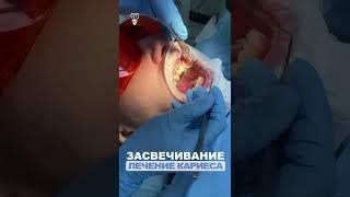 Лечение кариеса. Засвечивание. Treatment of caries.