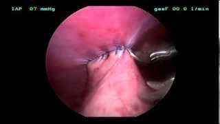 Canine Gastropexy  (Total Laparoscopic) Dr. Jeffrey Runge DVM, DACVS