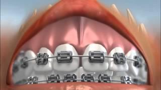 Frenectomy Surgery - AAOMS Video