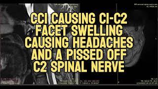 CCI Causing C1-C2 Facet Swelling Causing Headaches and a Pissed Off C2 Spinal Nerve