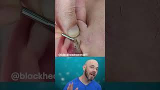 Blackheads galore in this ear!(credit: @blackheadremoval1 on TT) #satisfying #blackheads