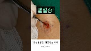 손목 결절종 수술 (양성종양 물혹 진단 MRI 초음파 수술 흉터 비용 실비보험 성형외과 병원 ganglion cyst pimple surgery seoul korea)[아문TV]