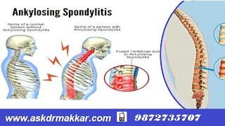 Hlab27 Ankylosing Spondolysis Permanent Treatment-Ankylosis Homeopathic - Explanations how to cure .