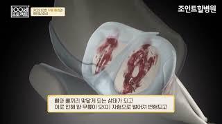 채널A 100세프로젝트 지긋지긋한 무릎통증과 헤어질결심 2023 04 2 유정수원장님 인터뷰