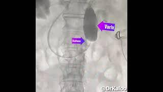 BRTO (Balloon Retrograde Transvenous Obliteration of Shunt)