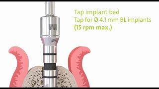 Straumann® PURE Ceramic Implant Monotype: Step by Step.