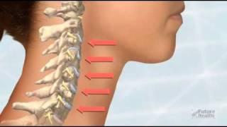 Treatment of Neck Pain by Future Health Software