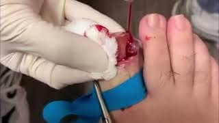 Ingrown toe nail removal, foot nail corn